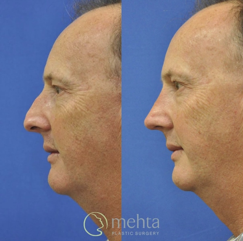 Rhinoplasty Before & After Gallery - Patient 528853 - Image 1