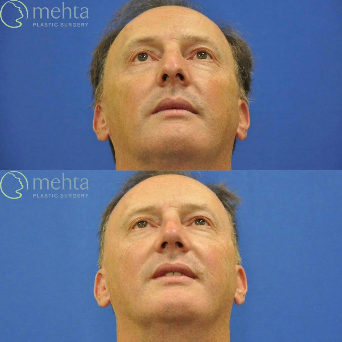 Rhinoplasty Before & After Gallery - Patient 528853 - Image 6