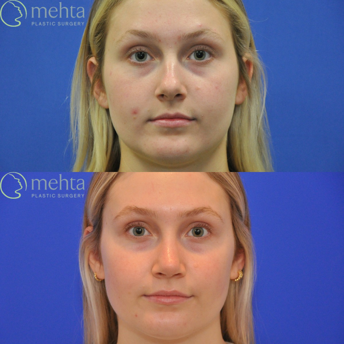 Rhinoplasty Before & After Gallery - Patient 366214 - Image 6