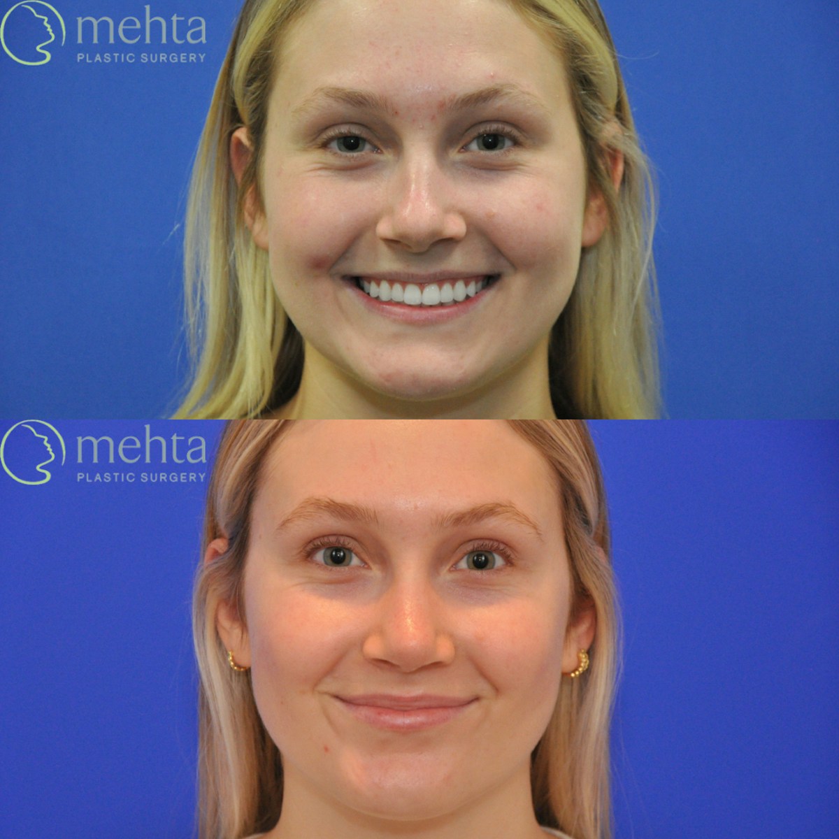 Rhinoplasty Before & After Gallery - Patient 366214 - Image 8