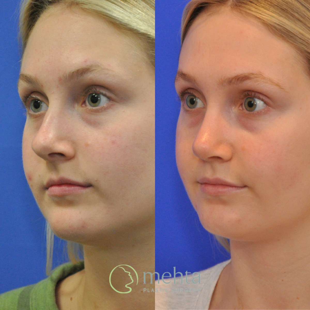 Rhinoplasty Before & After Gallery - Patient 366214 - Image 2