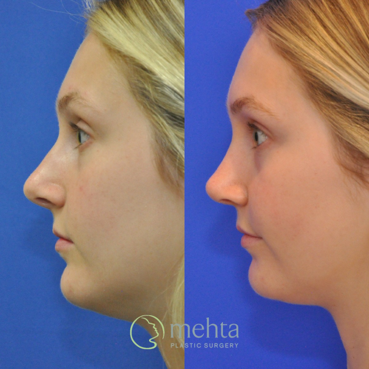 Rhinoplasty Before & After Gallery - Patient 366214 - Image 1