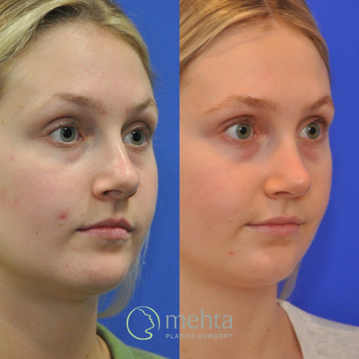Rhinoplasty Before & After Gallery - Patient 366214 - Image 3