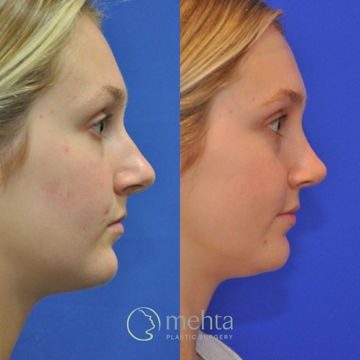 Rhinoplasty Before & After Gallery - Patient 366214 - Image 4
