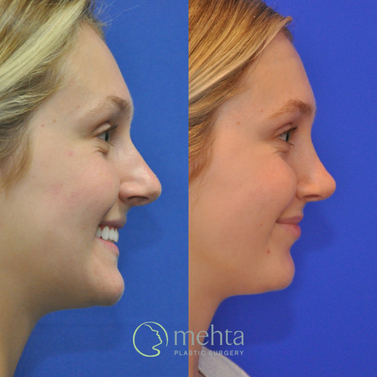 Rhinoplasty Before & After Gallery - Patient 366214 - Image 5