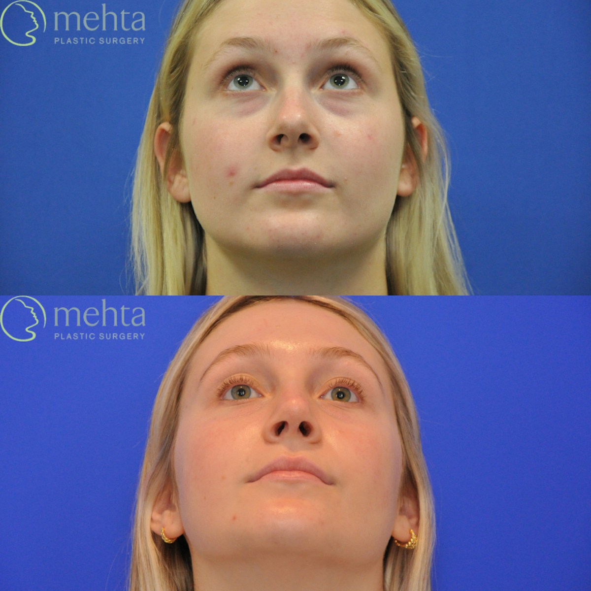 Rhinoplasty Before & After Gallery - Patient 366214 - Image 7