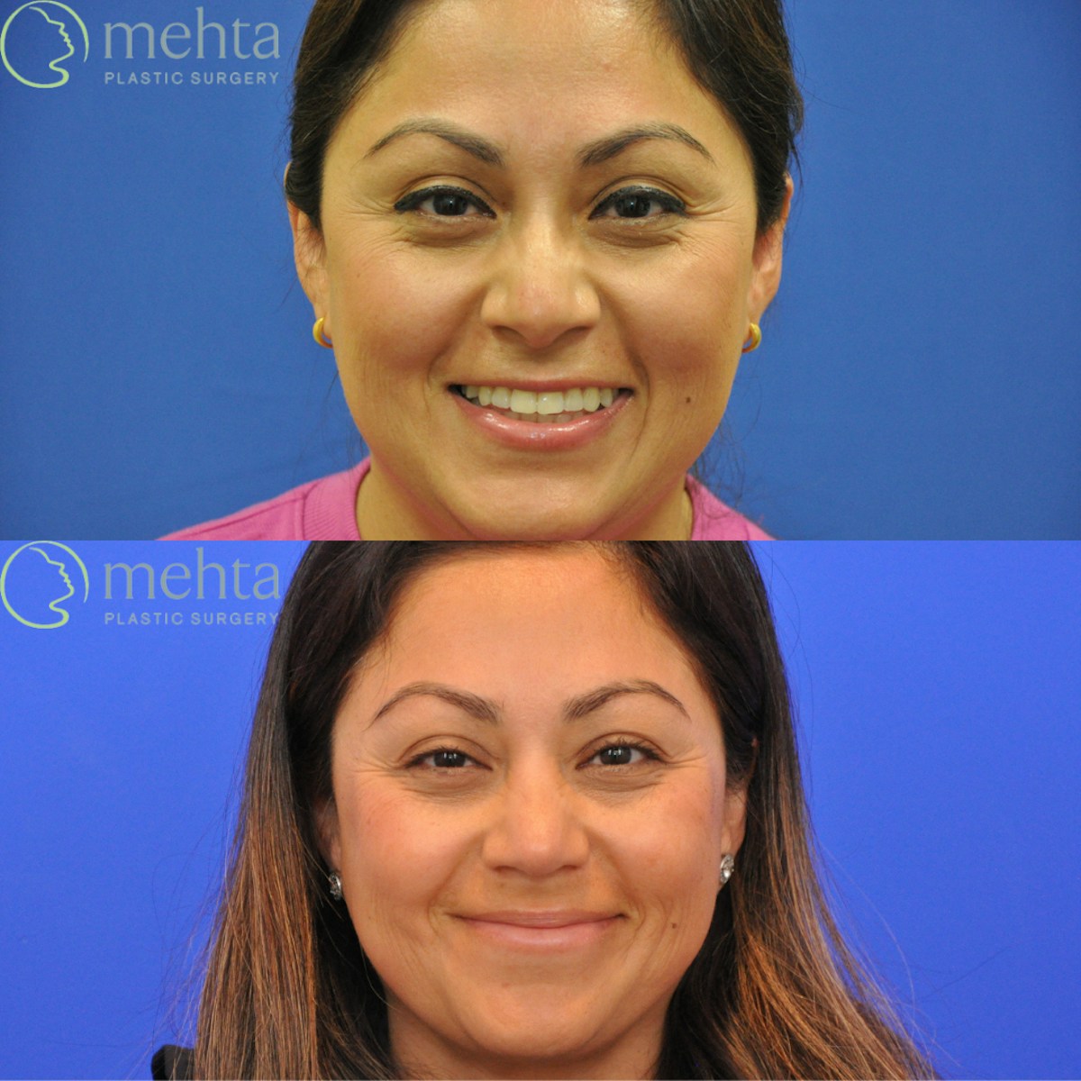 Rhinoplasty Before & After Gallery - Patient 342390 - Image 4