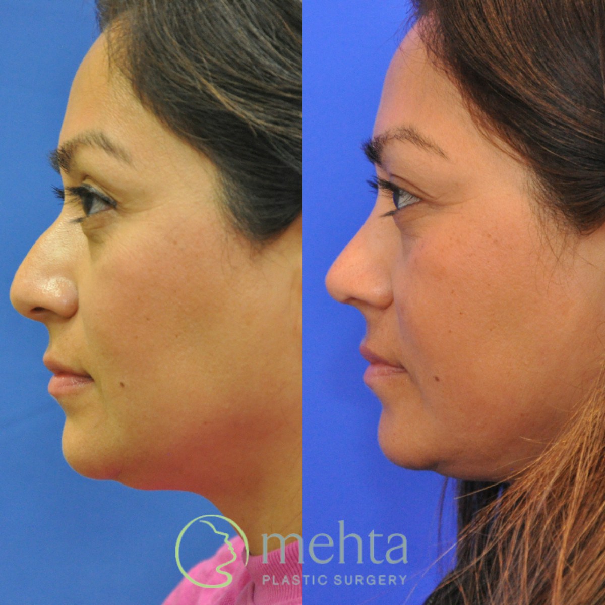 Rhinoplasty Before & After Gallery - Patient 342390 - Image 1
