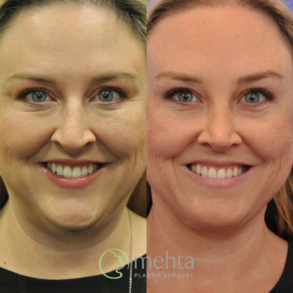 Rhinoplasty Before & After Gallery - Patient 454569 - Image 6