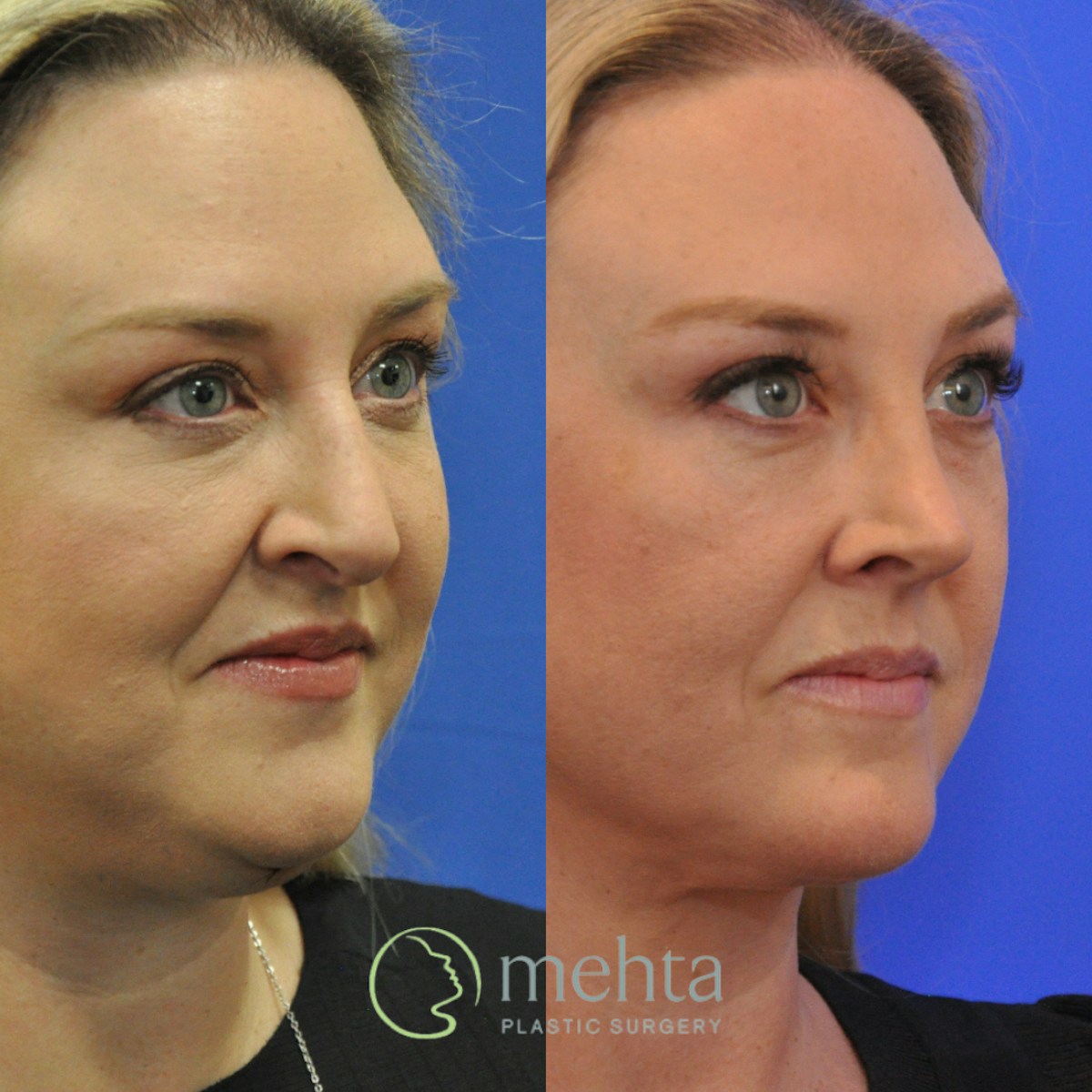 Rhinoplasty Before & After Gallery - Patient 454569 - Image 3