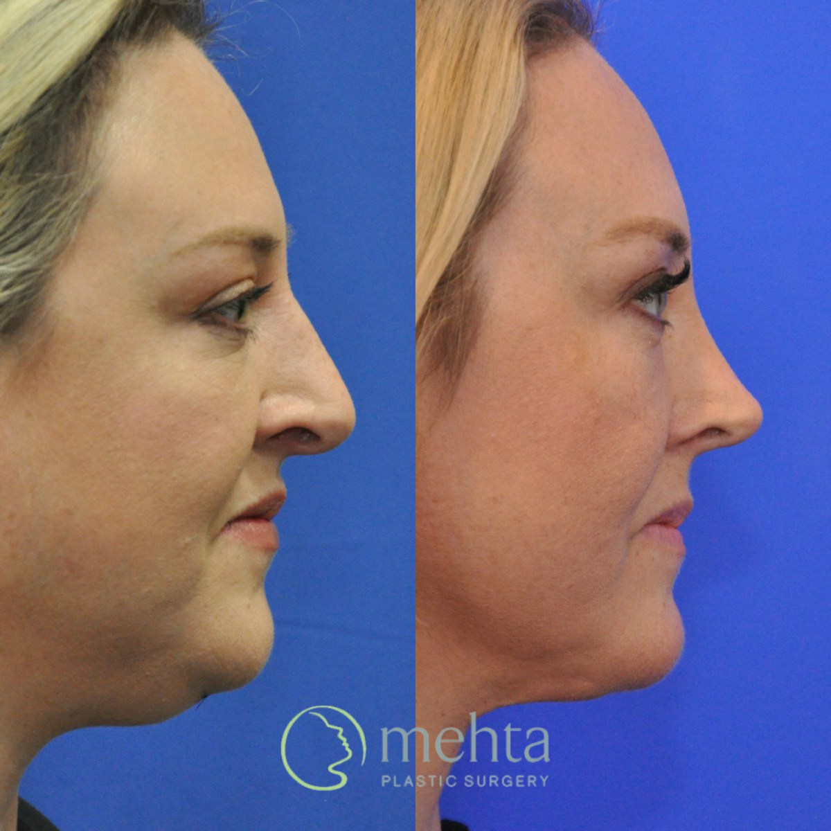 Rhinoplasty Before & After Gallery - Patient 454569 - Image 4