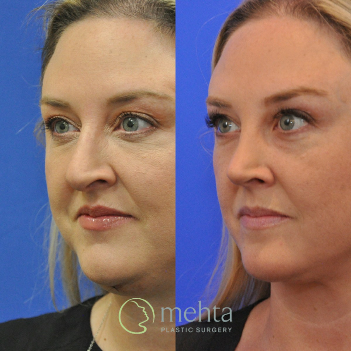 Rhinoplasty Before & After Gallery - Patient 454569 - Image 2