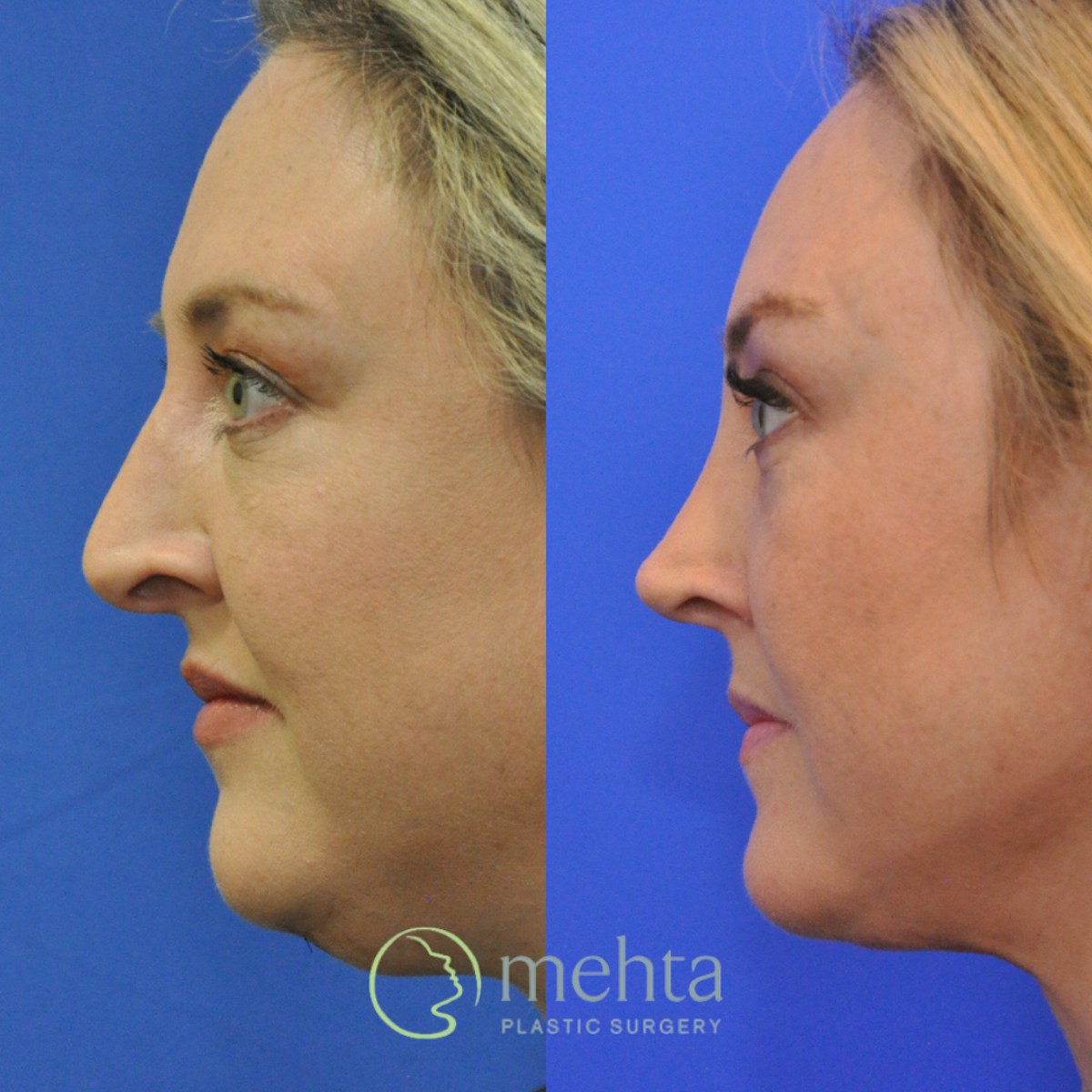 Rhinoplasty Before & After Gallery - Patient 454569 - Image 1