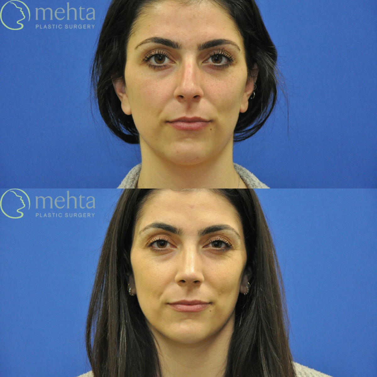 Rhinoplasty Before & After Gallery - Patient 124260 - Image 5