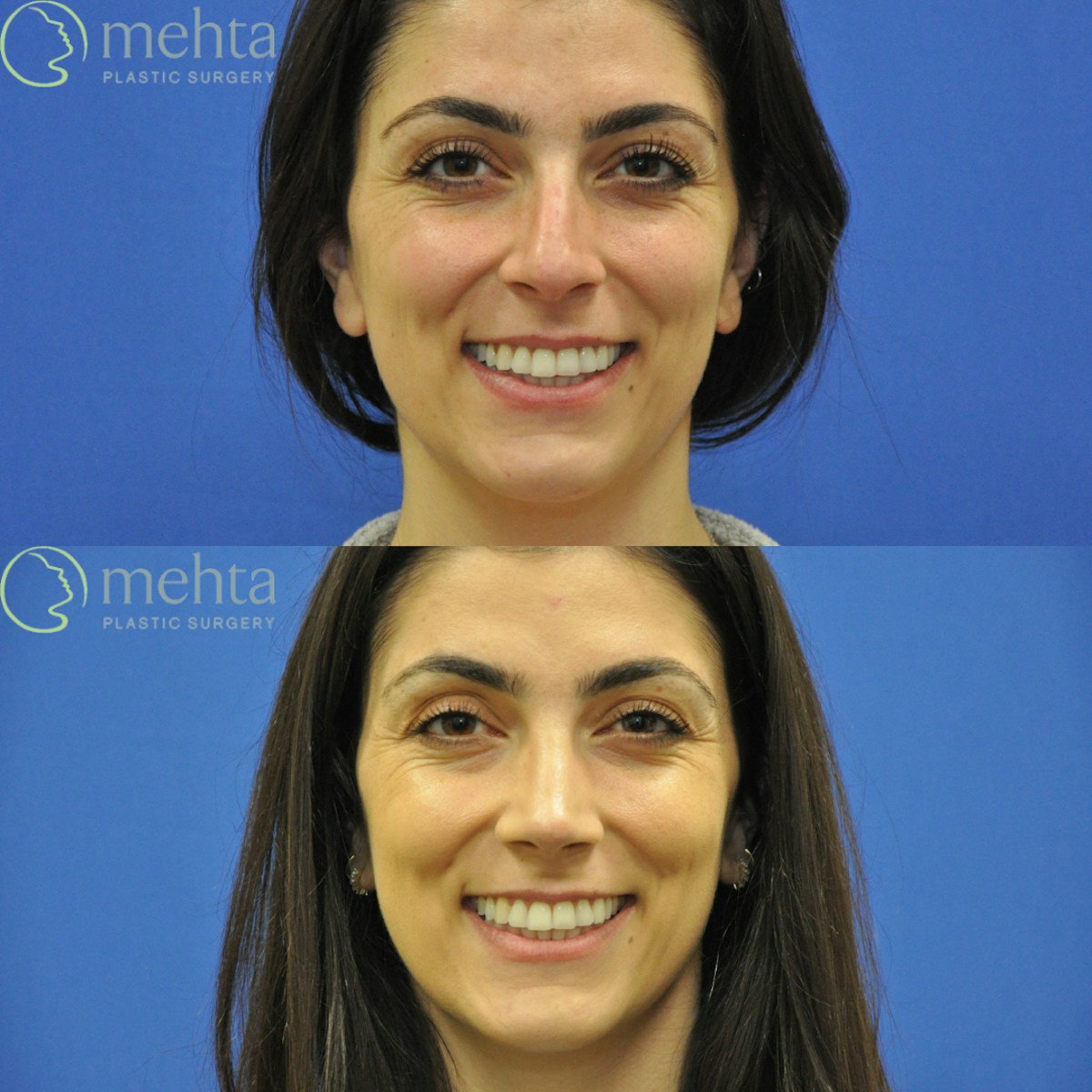 Rhinoplasty Before & After Gallery - Patient 124260 - Image 6
