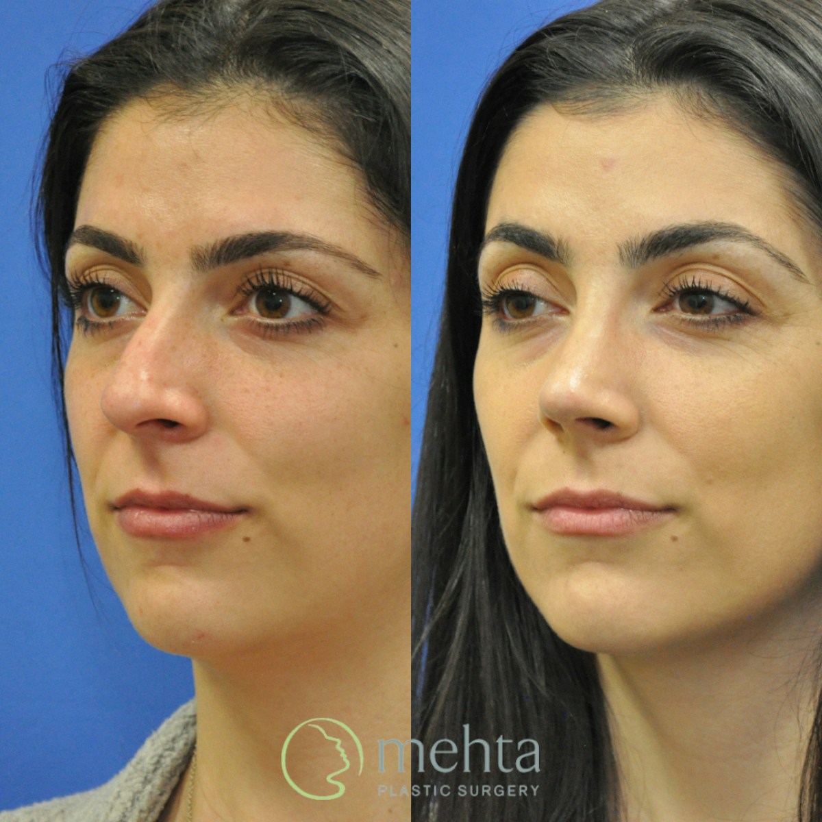 Rhinoplasty Before & After Gallery - Patient 124260 - Image 2
