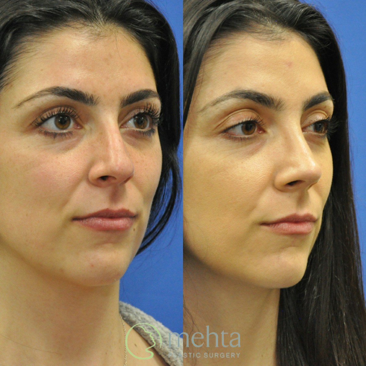 Rhinoplasty Before & After Gallery - Patient 124260 - Image 3