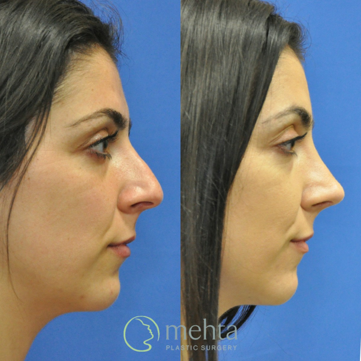 Rhinoplasty Before & After Gallery - Patient 124260 - Image 4