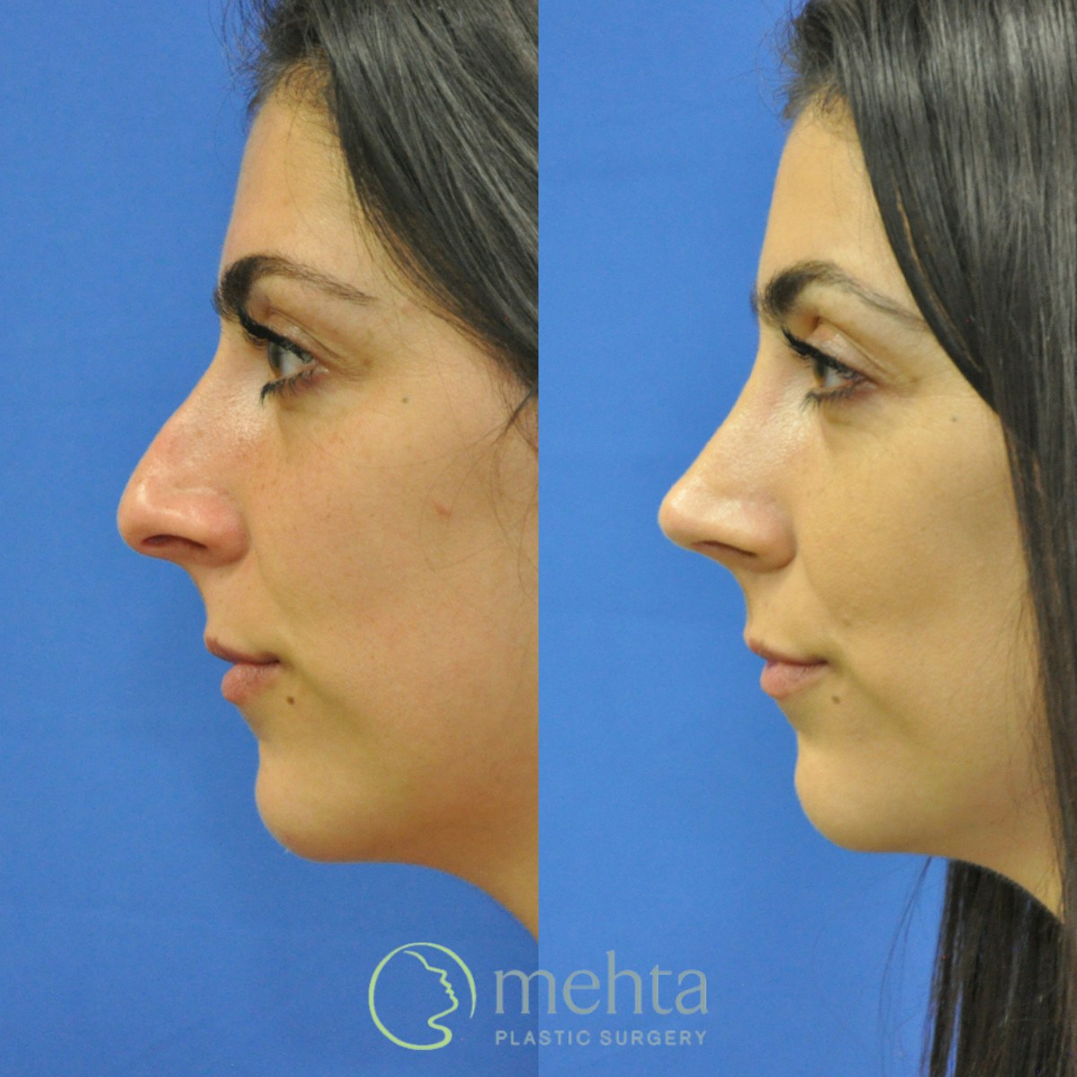 Rhinoplasty Before & After Gallery - Patient 124260 - Image 1