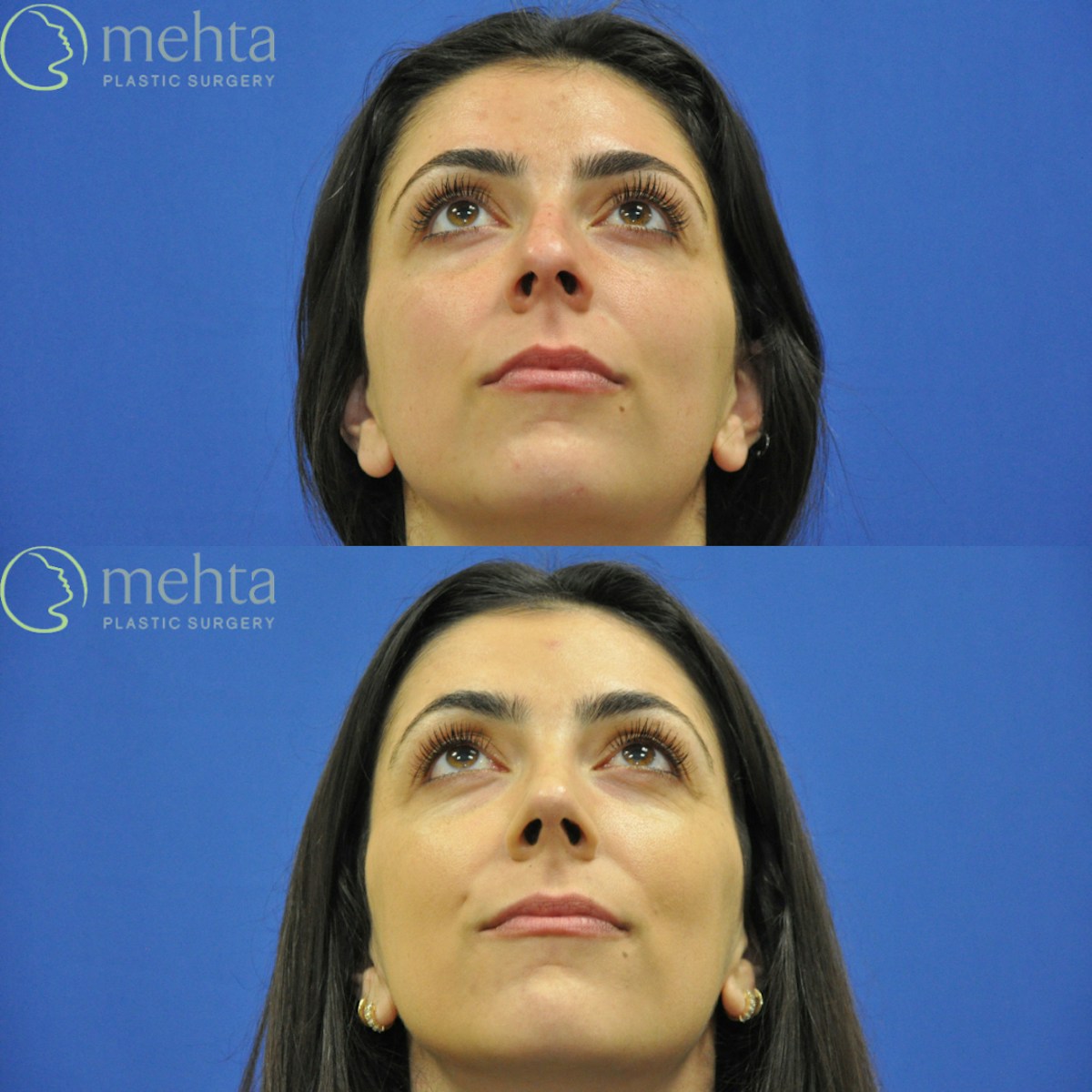 Rhinoplasty Before & After Gallery - Patient 124260 - Image 7