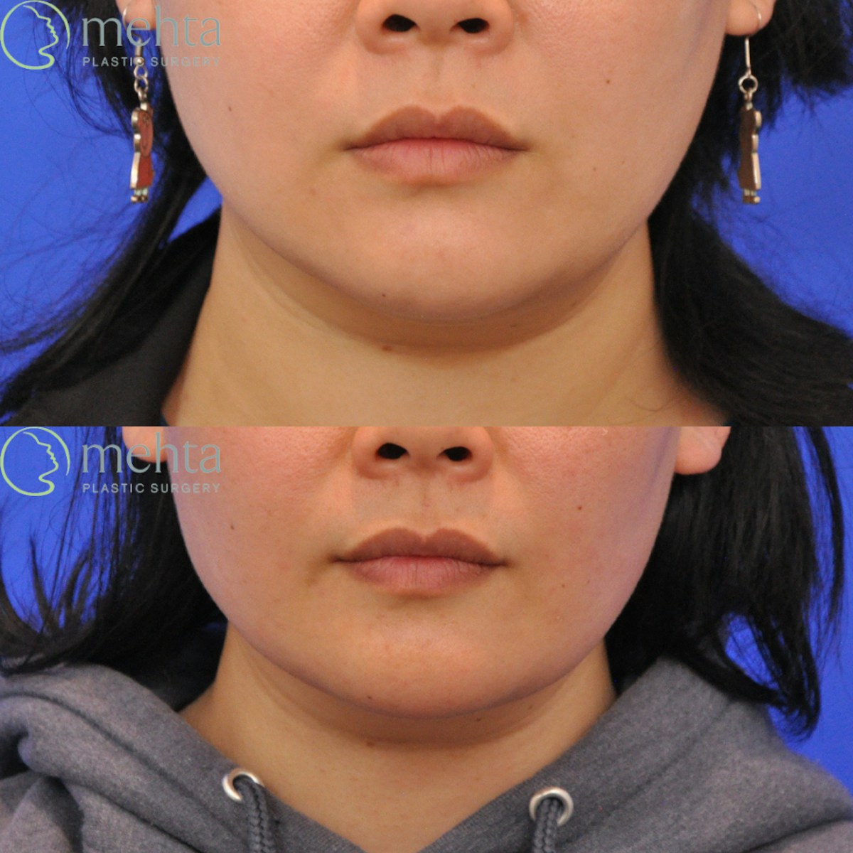 Neck Liposuction Before & After Gallery - Patient 429252 - Image 1