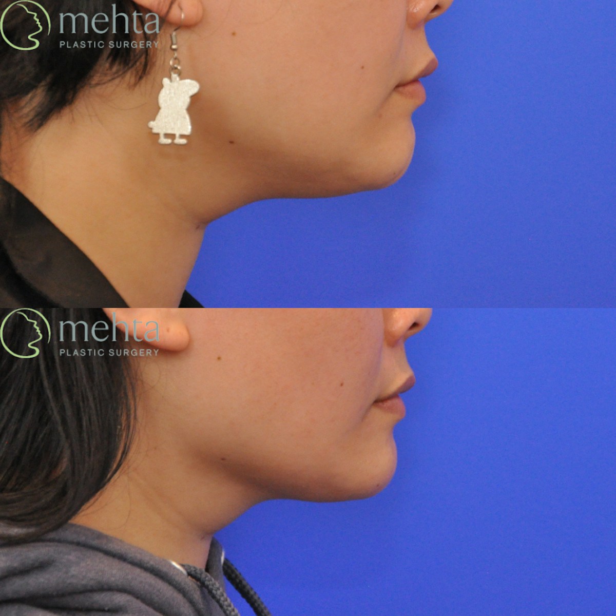 Neck Liposuction Before & After Gallery - Patient 429252 - Image 3