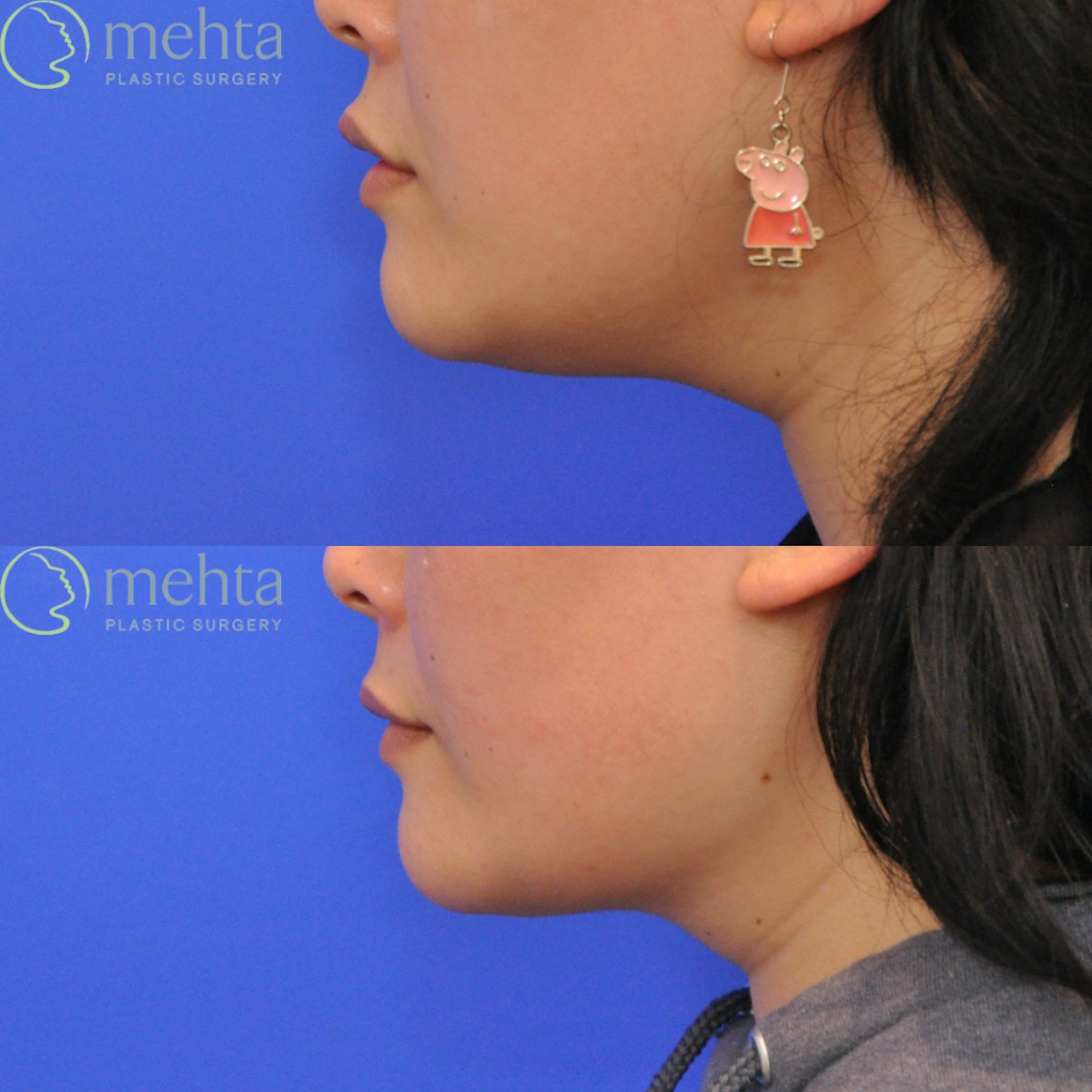Neck Liposuction Before & After Gallery - Patient 429252 - Image 5