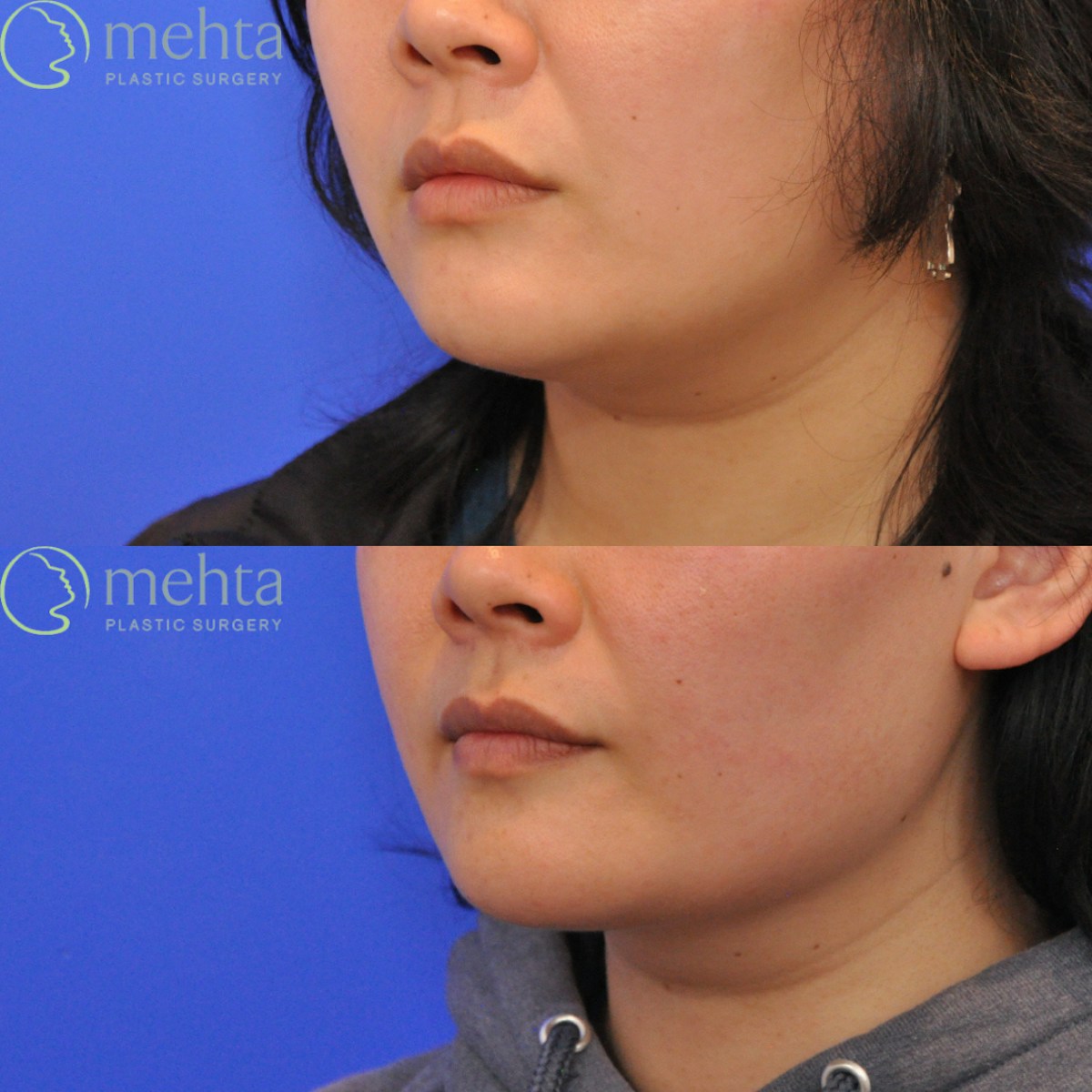 Neck Liposuction Before & After Gallery - Patient 429252 - Image 4
