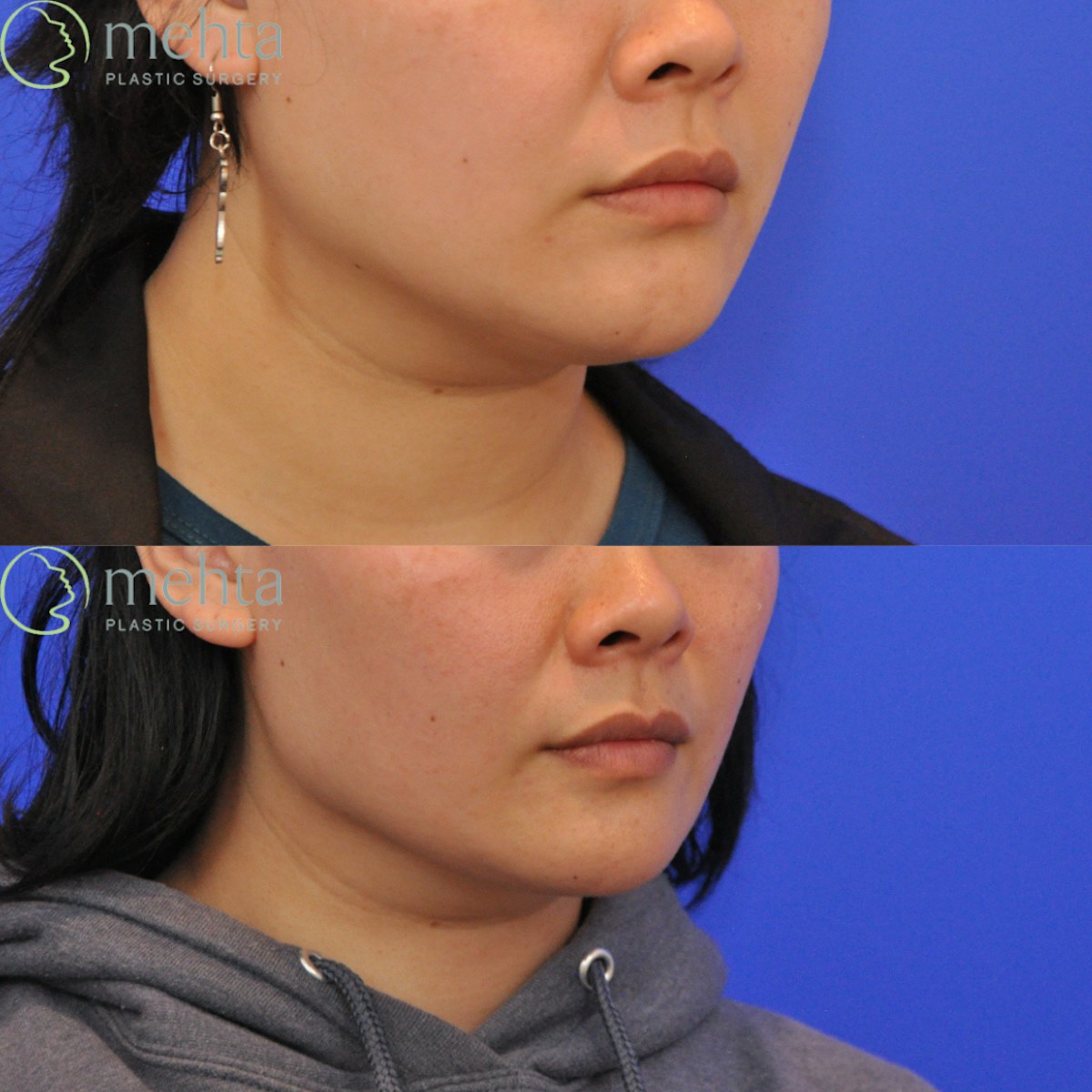 Neck Liposuction Before & After Gallery - Patient 429252 - Image 2