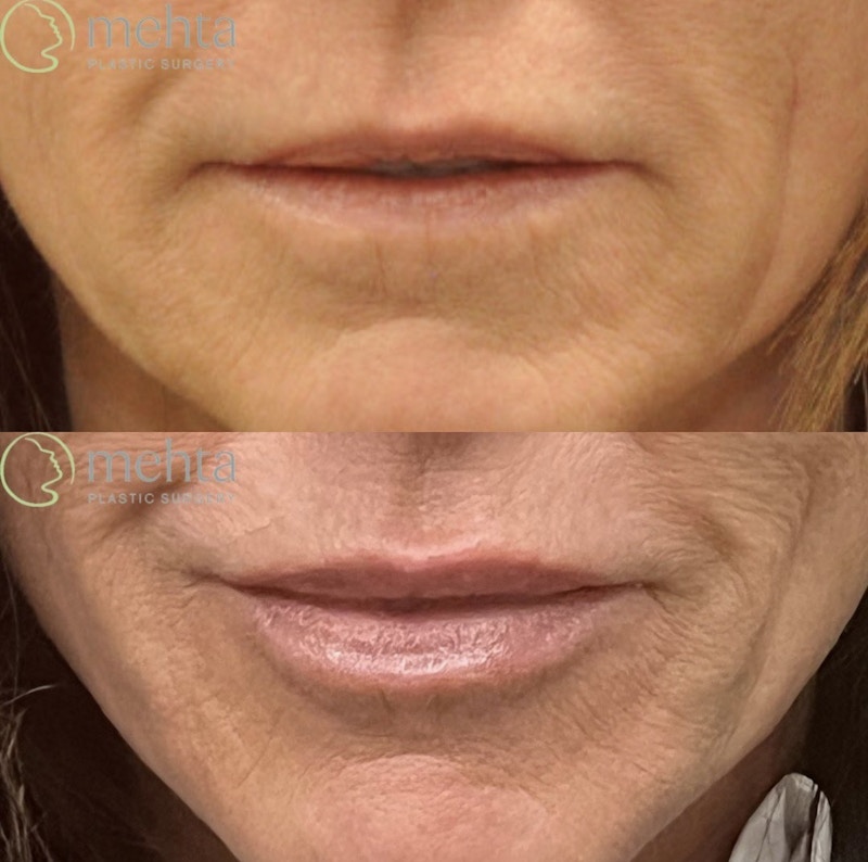 Lip Augmentation Before & After Gallery - Patient 141174 - Image 1