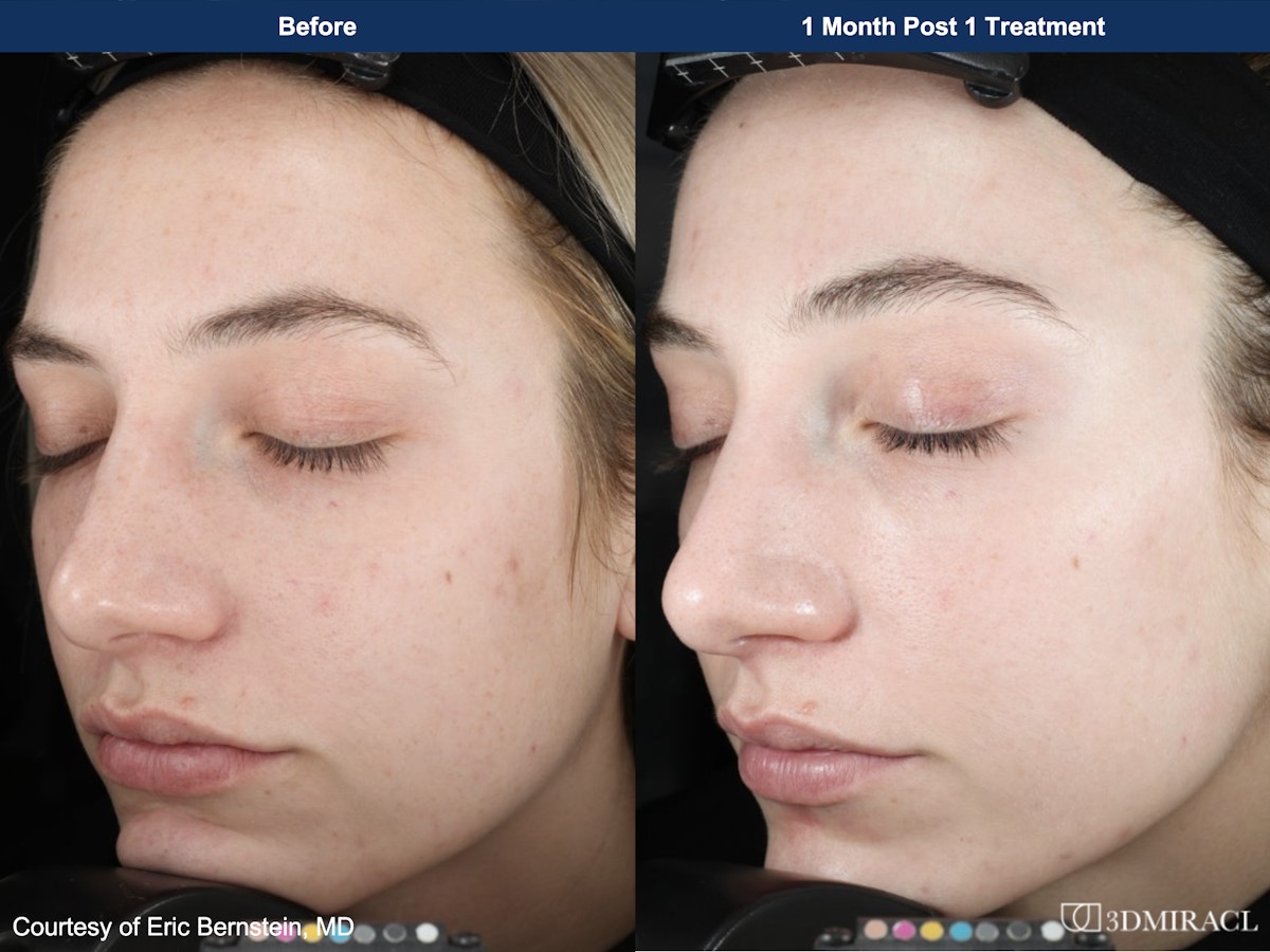 UltraClear® Laser Before & After Gallery - Patient 143163 - Image 1