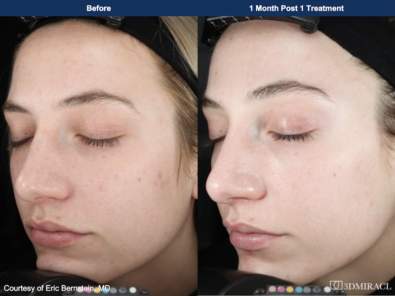 UltraClear® Laser Before & After Gallery - Patient 143163 - Image 1