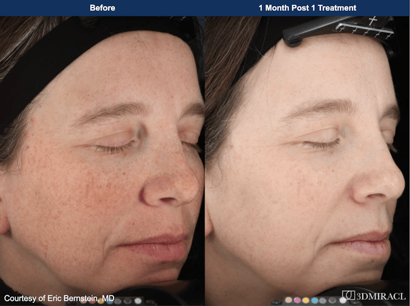 UltraClear® Laser Before & After Gallery - Patient 480618 - Image 1
