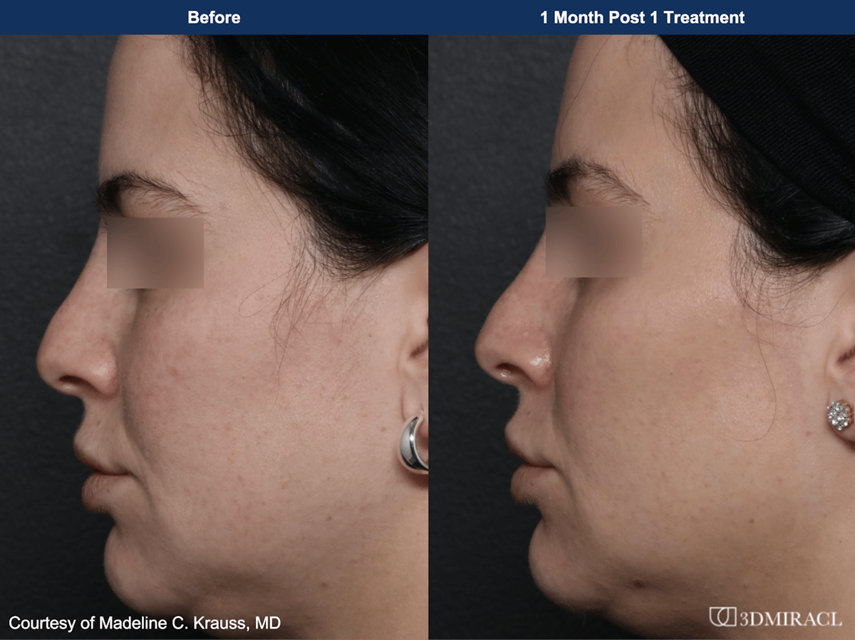 UltraClear® Laser Before & After Gallery - Patient 560054 - Image 1