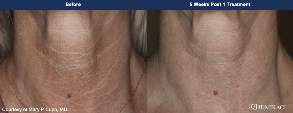 UltraClear® Laser Before & After Gallery - Patient 272542 - Image 1