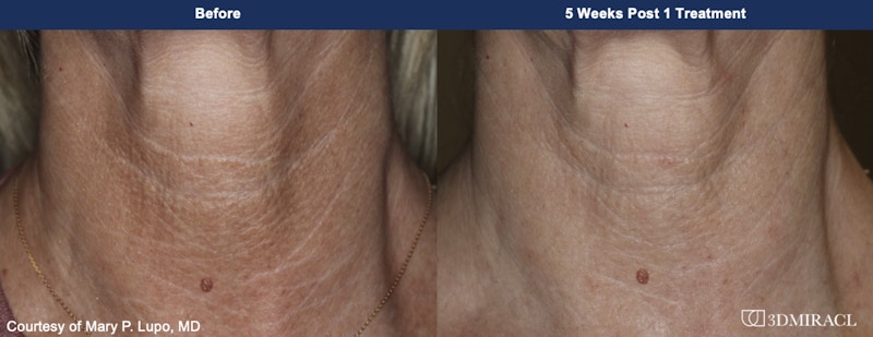 UltraClear® Laser Before & After Gallery - Patient 272542 - Image 1
