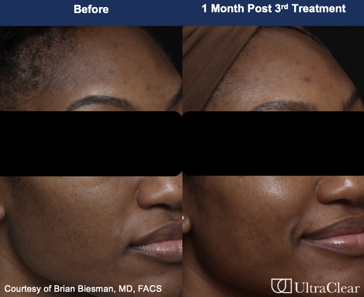UltraClear® Laser Before & After Gallery - Patient 589647 - Image 1