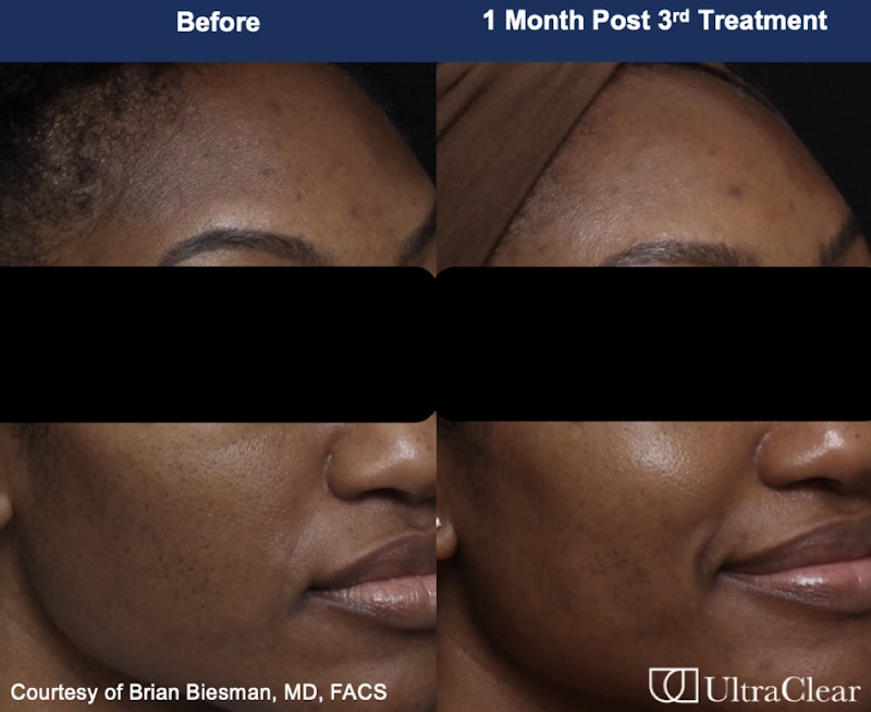UltraClear® Laser Before & After Gallery - Patient 589647 - Image 1