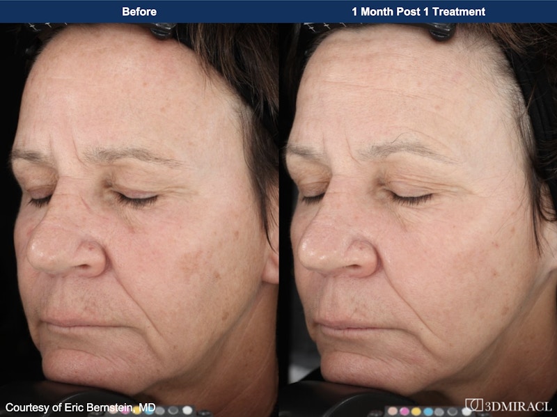 UltraClear® Laser Before & After Gallery - Patient 137656 - Image 1
