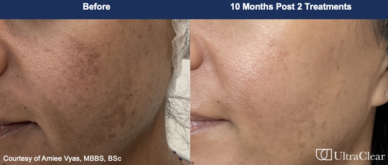UltraClear® Laser Before & After Gallery - Patient 325027 - Image 1