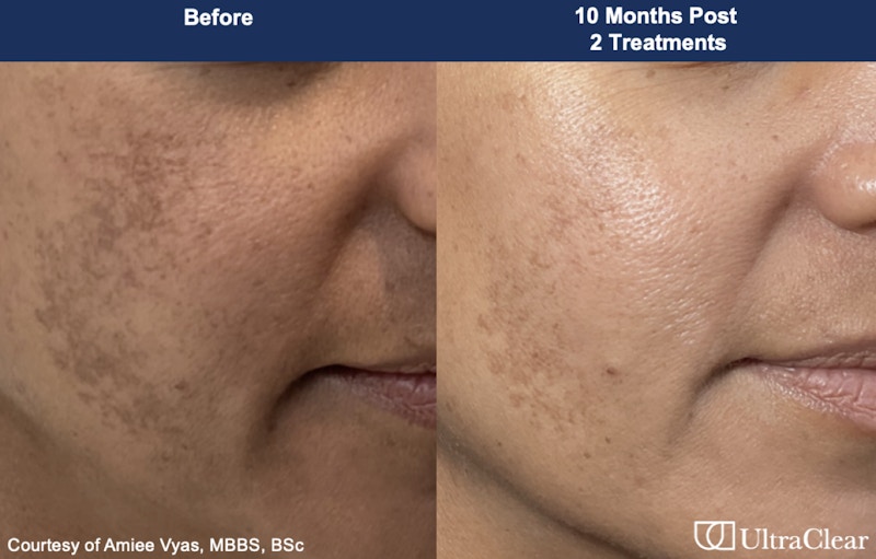 UltraClear® Laser Before & After Gallery - Patient 346754 - Image 1