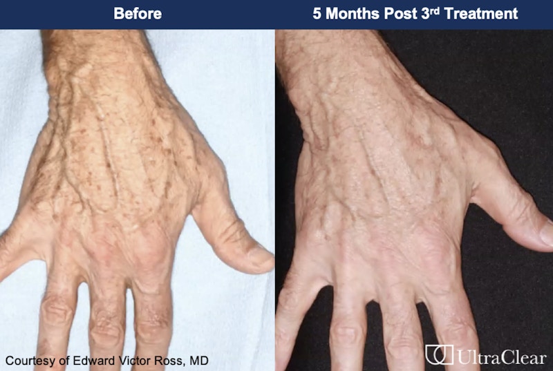 UltraClear® Laser Before & After Gallery - Patient 547639 - Image 1
