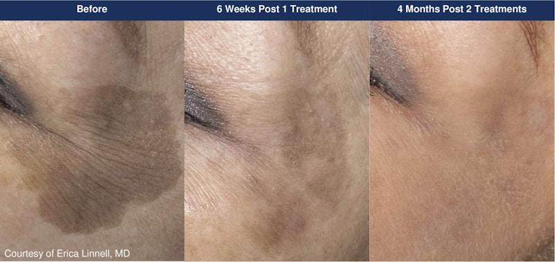 UltraClear® Laser Before & After Gallery - Patient 370909 - Image 1