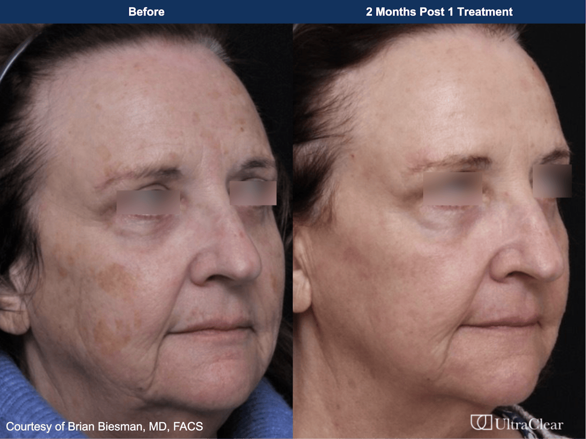 UltraClear® Laser Before & After Gallery - Patient 520684 - Image 1
