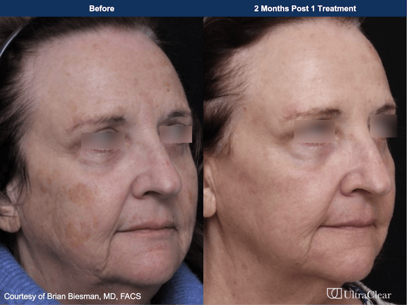 UltraClear® Laser Before & After Gallery - Patient 520684 - Image 1