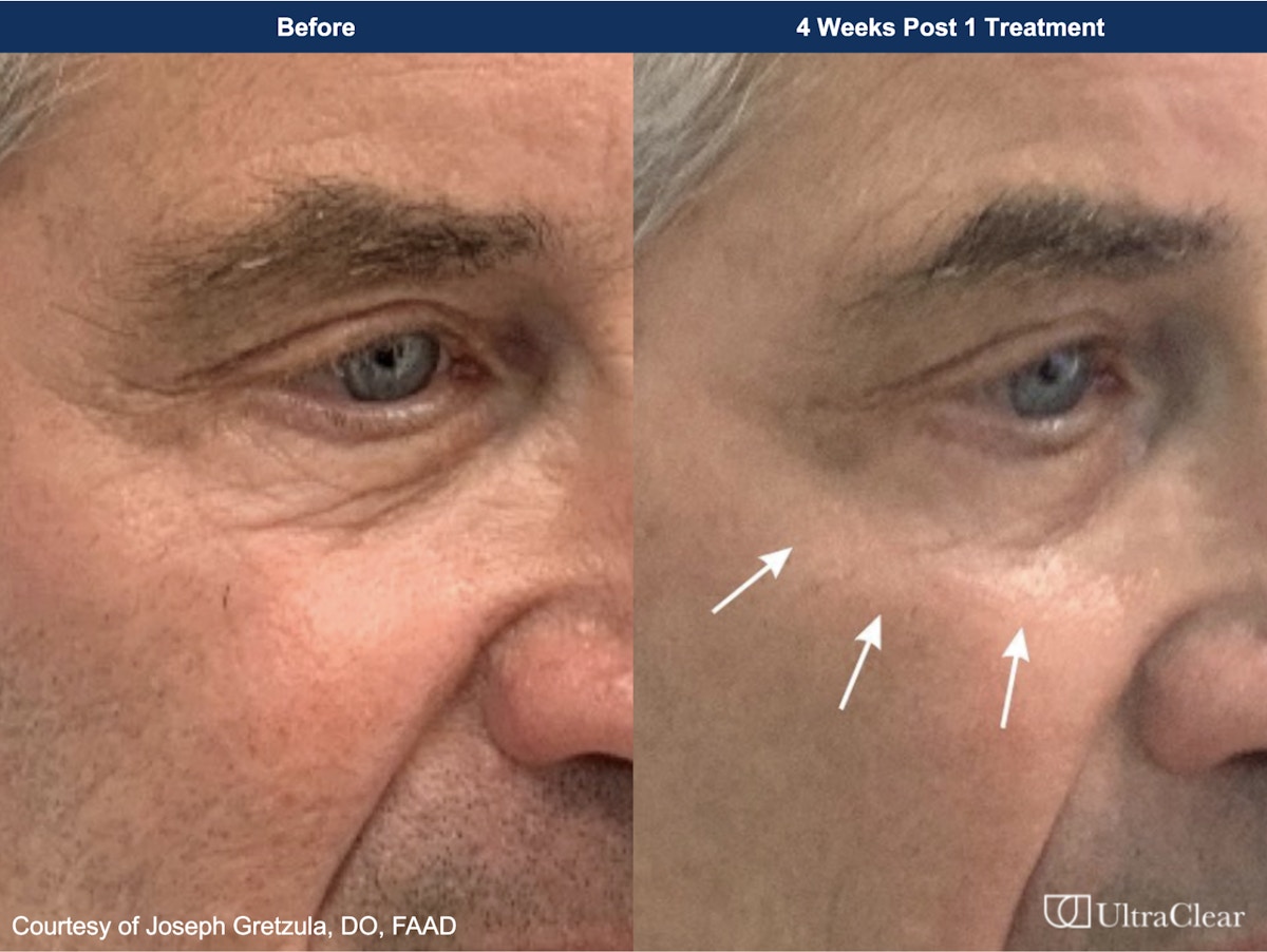 UltraClear® Laser Before & After Gallery - Patient 315409 - Image 1