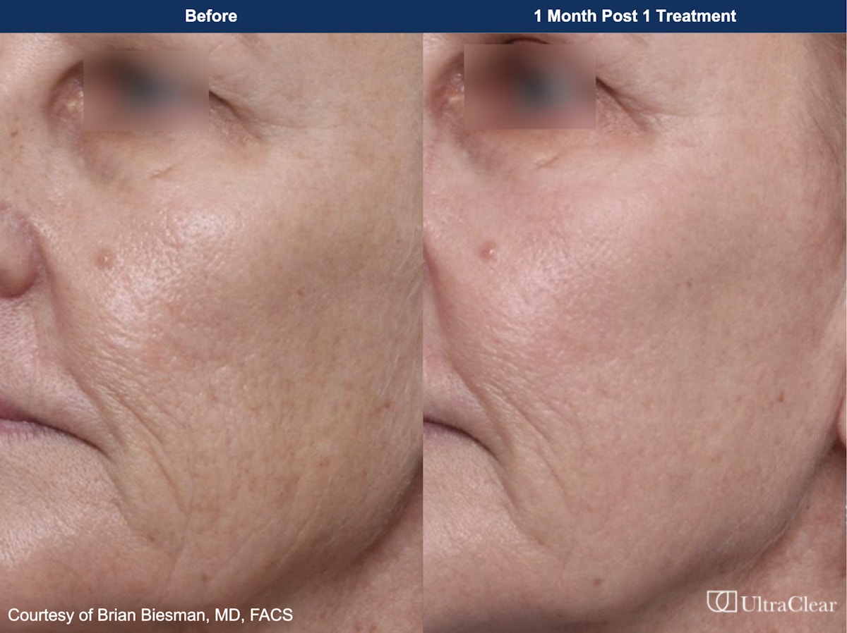 UltraClear® Laser Before & After Gallery - Patient 222328 - Image 1
