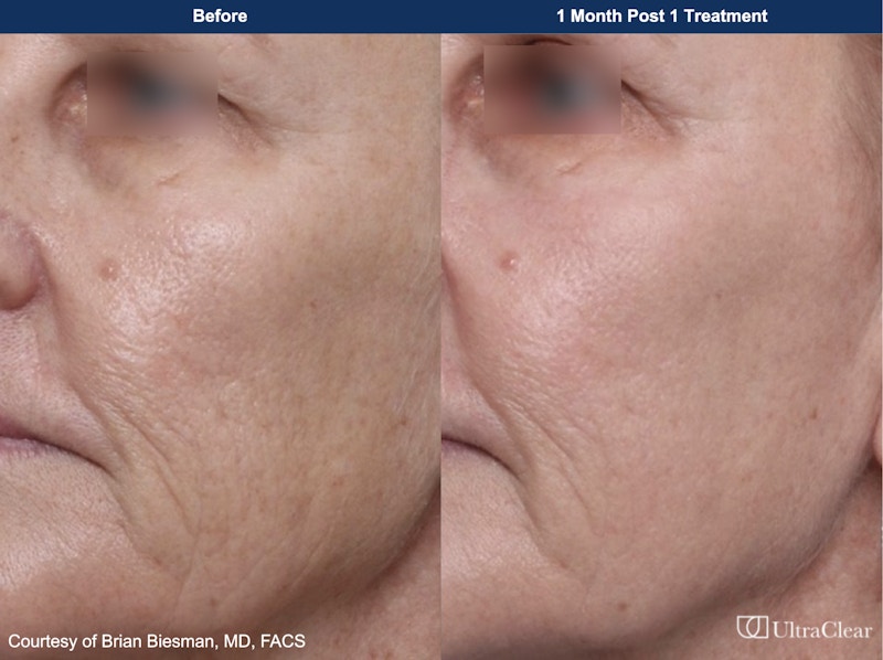 UltraClear® Laser Before & After Gallery - Patient 222328 - Image 1