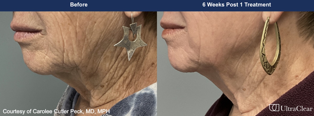 UltraClear® Laser Before & After Gallery - Patient 169374 - Image 1