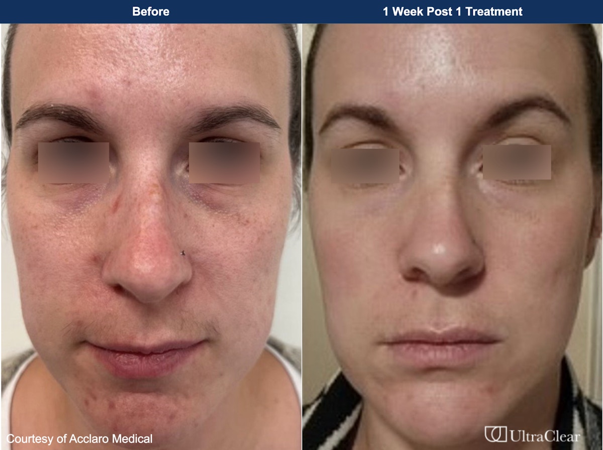 UltraClear® Laser Before & After Gallery - Patient 330074 - Image 1